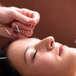 4 Reasons Why You Should Choose Acupuncture