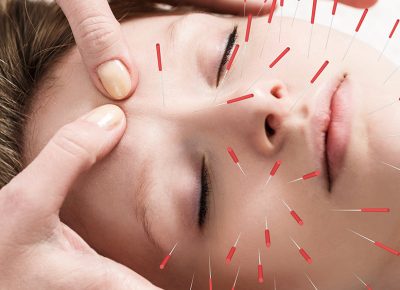 Feel Better and Look Younger After Facial Acupuncture 