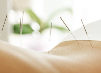 Acupuncture in Northern Liberties