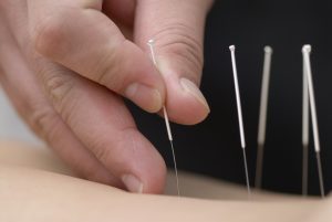 Acupuncture Clinic Near Saint Joseph’s University